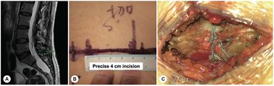 Accurate diagnosis and treatment of sacral meningeal cysts without spinal nerve root fibres: identifying leakage orificium using high-resolution spherical arbitrary-dimensional reconstructing magnetic resonance imaging